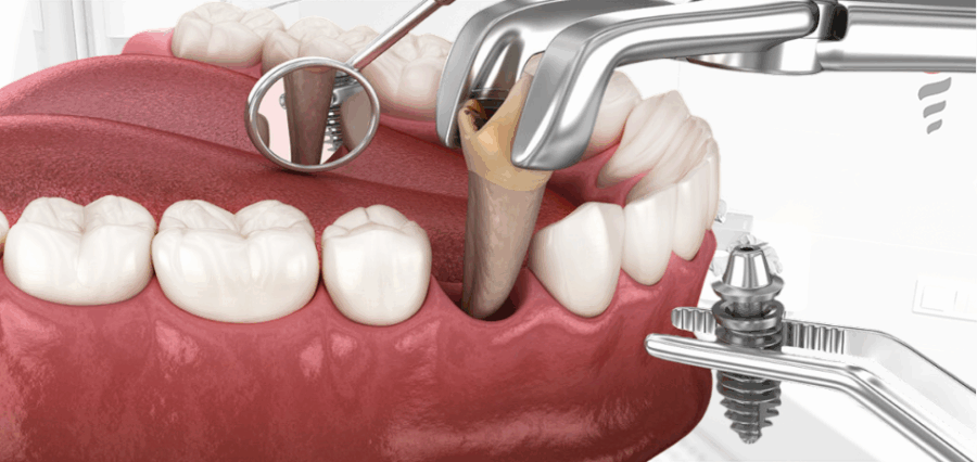 Одномоментная имплантация зубов в Запорожье